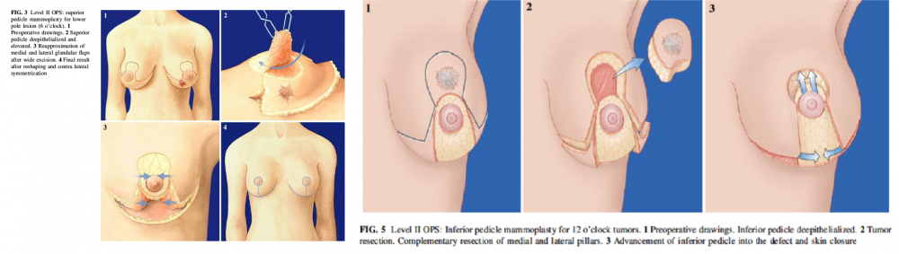 inferior pedicle mammoplasty technique